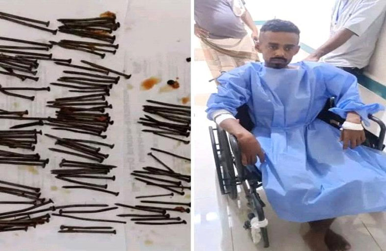 استخراج  117 مسماراً من معدة مريض