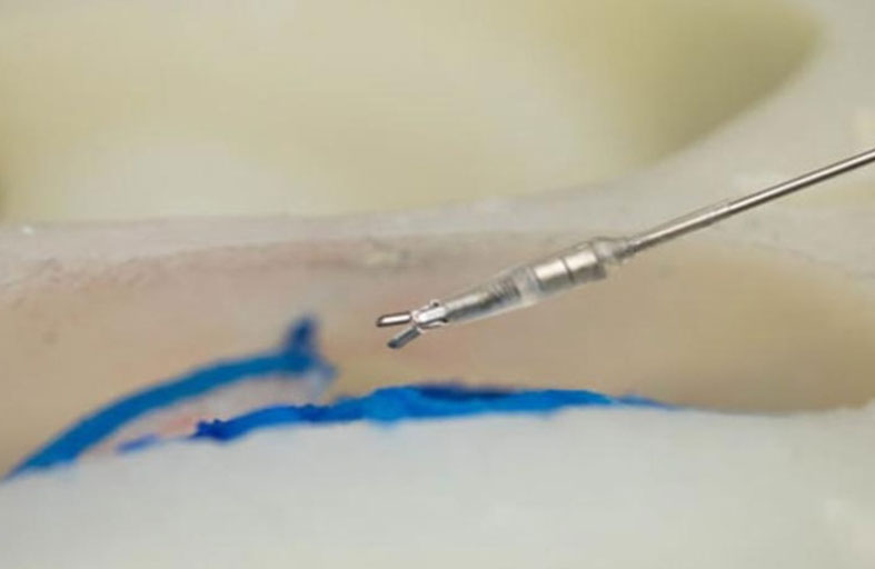 روبوتات دقيقة تنفذ جراحات الدماغ بدون مشرط