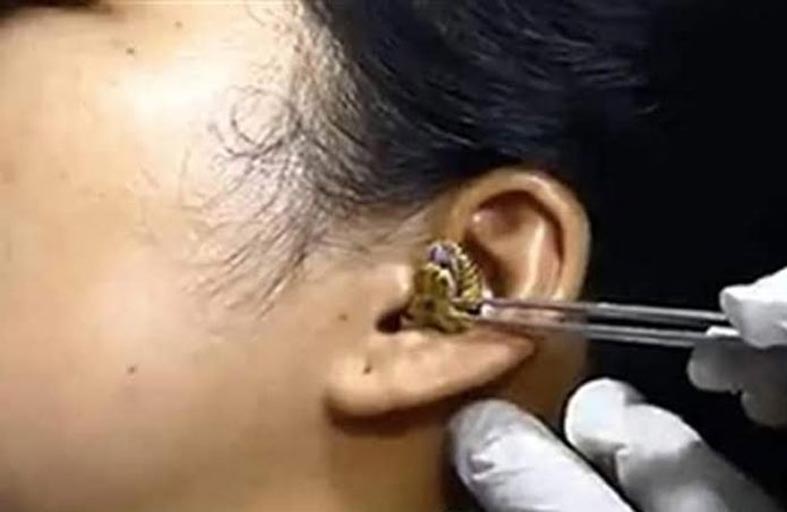 طبيب يستخرج ثعبانا من أذن امرأة