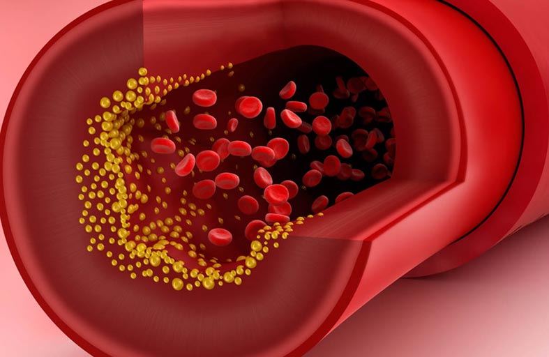 ارتفاع الكوليسترول في الدم.. علامات لا تهملها