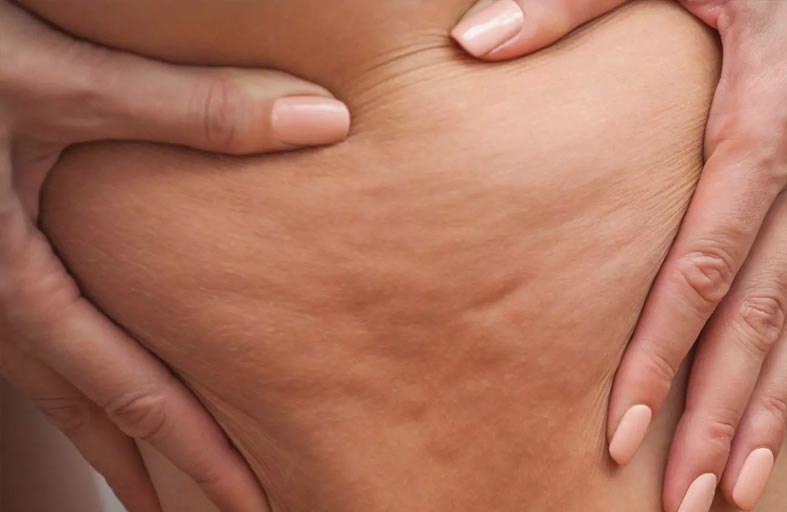 السيلوليت..أسباب وحلول