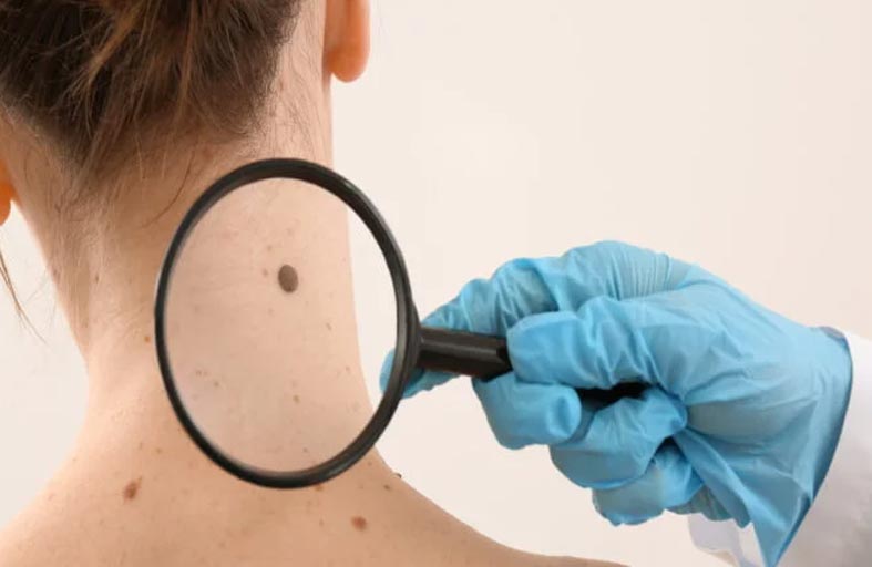 أخصائي أورام يكشف طرق الوقاية من سرطان الجلد