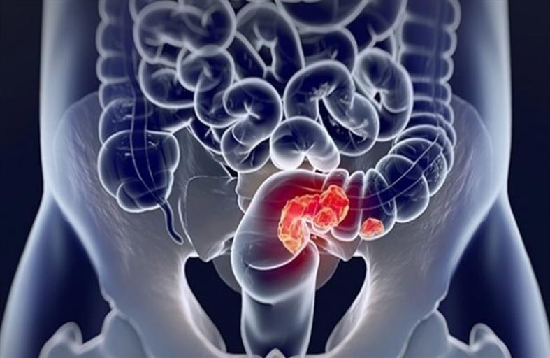 نتائج واعدة للقاح المضاد لسرطان البنكرياس