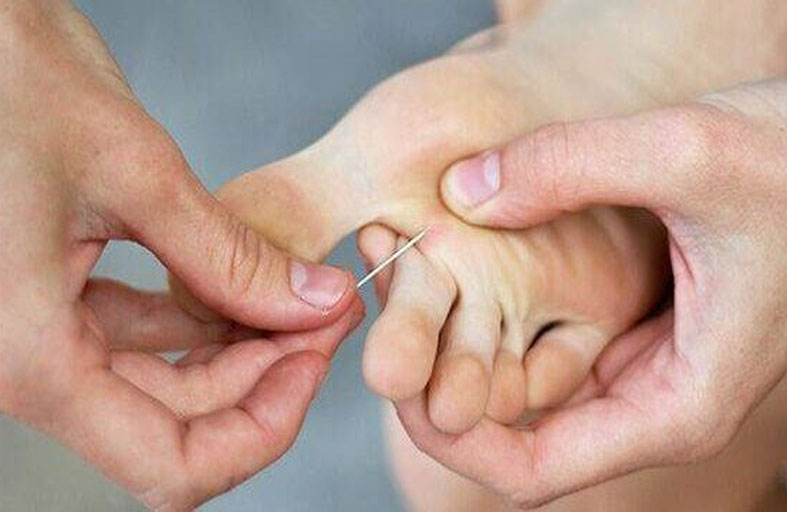 ماذا يحدث إذا لم تخرج شظية من جلدك؟