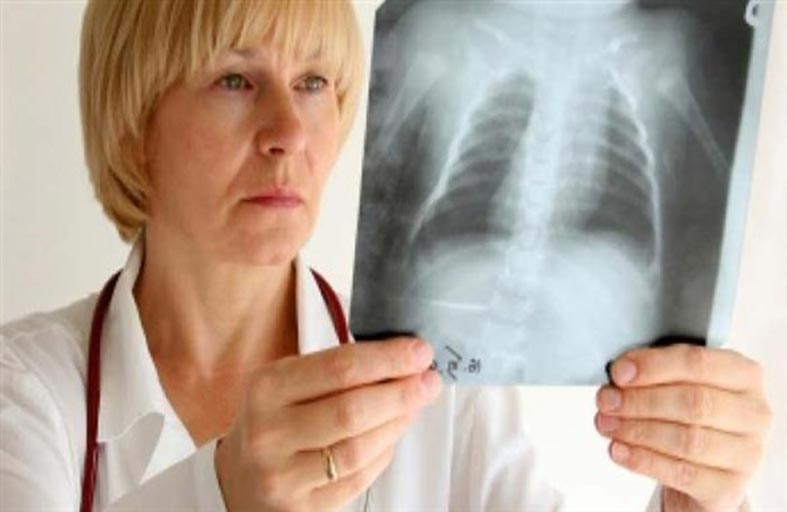 كوفيد- 19 يقوض جهود القضاء على السل