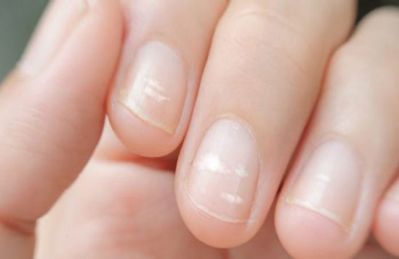 الخطوط على أظافرك.. «أسرار صحية» مرتبطة بالعمر
