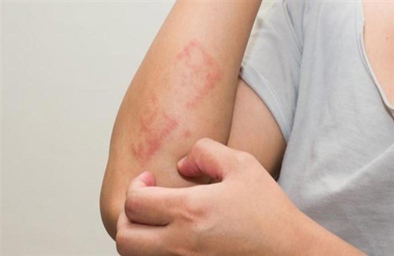 ماذا تعرف عن حساسية السمك؟