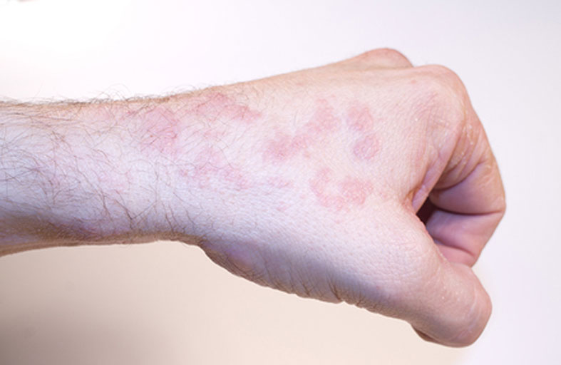 طرق الوقاية من سرطان الجلد