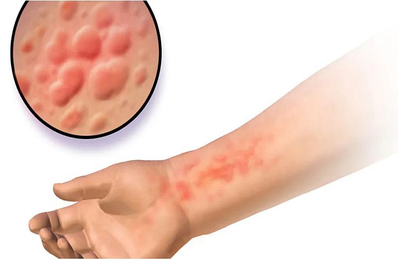 ما الذي نعرفه عن الحالة النادرة والغامضة المسببة للحساسية تجاه الماء؟