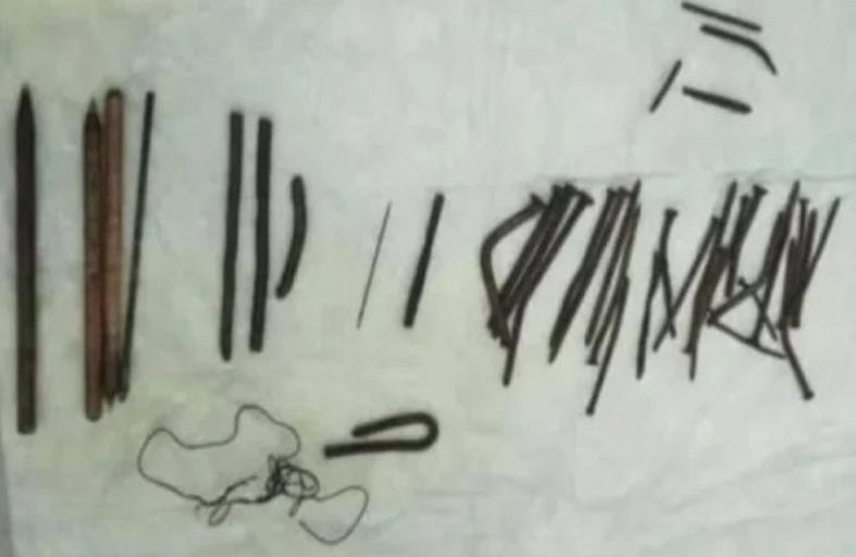 مسامير في معدة مريض 4 شهور