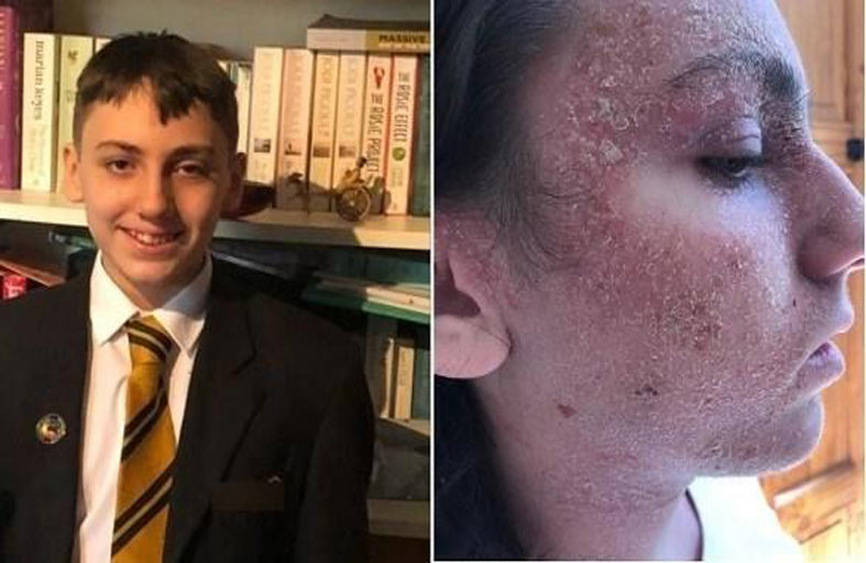 يطلب وضعه في غيبوبة ليتخلص من آلام الأكزيما