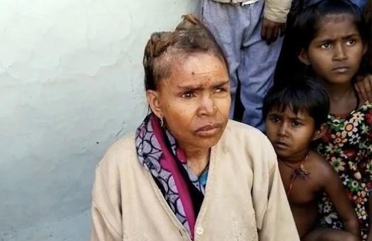 تحير الأطباء بـ«قرون» تنمو في رأسها