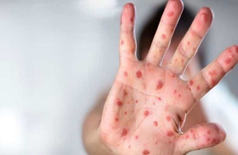 المغرب تُعلن الحصبة وباءً رسمياً