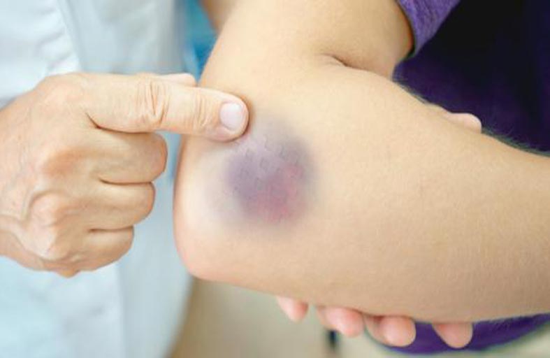 البقع الزرقاء أحد الأعراض المخيفة للسرطان 