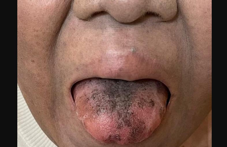 ينمو الشعر على لسانها بسبب مضاد حيوي 