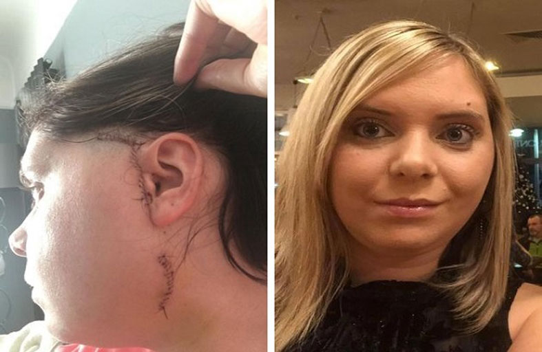 تخضع لعملية تغيير فك بسبب شطيرة برغر