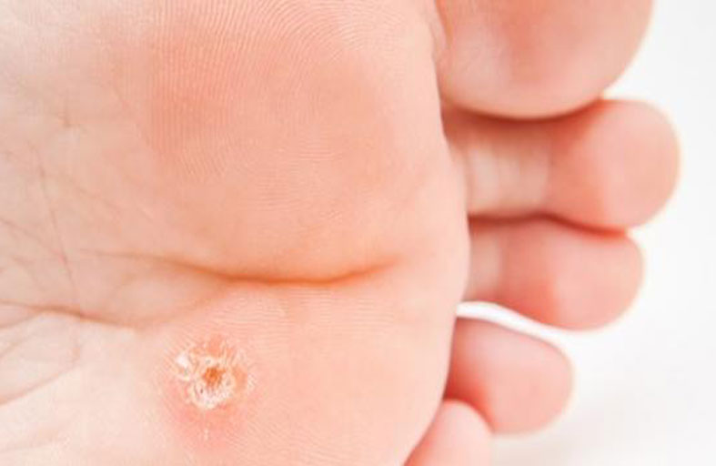 كيف تتخلص من مسامير اللحم في القدمين؟