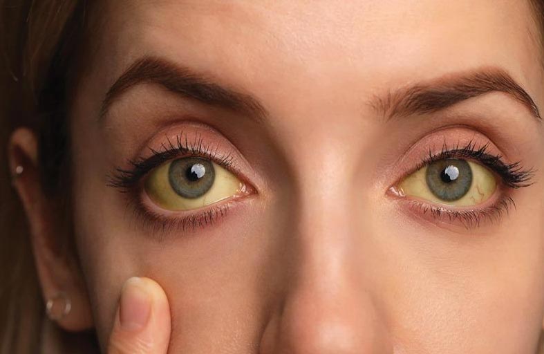 تحذير من الحمّى الصفراء للمسافرين صيفاً إلى هذه المناطق