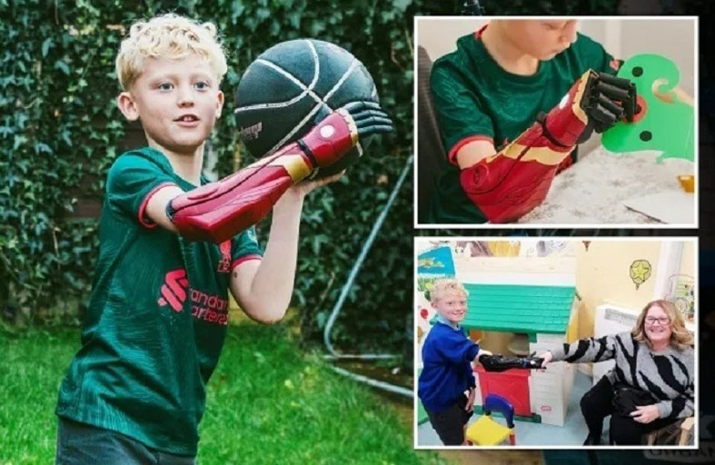 ولد بدون ذراع يحصل على طرف إلكتروني