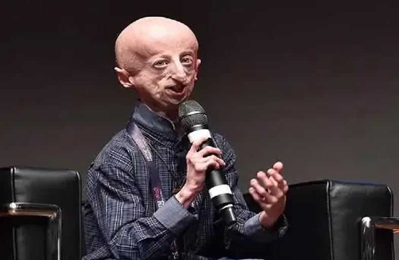 وفاة سامي باسو .. المصاب بالشيخوخة المبكرة