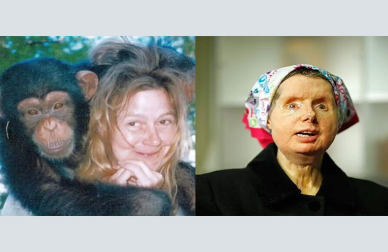 ترميم ملامح امرأة مزّق وجهها الشمبانزي 