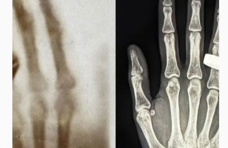 أول صورة بالأشعة السينية ليد بشرية في الفضاء