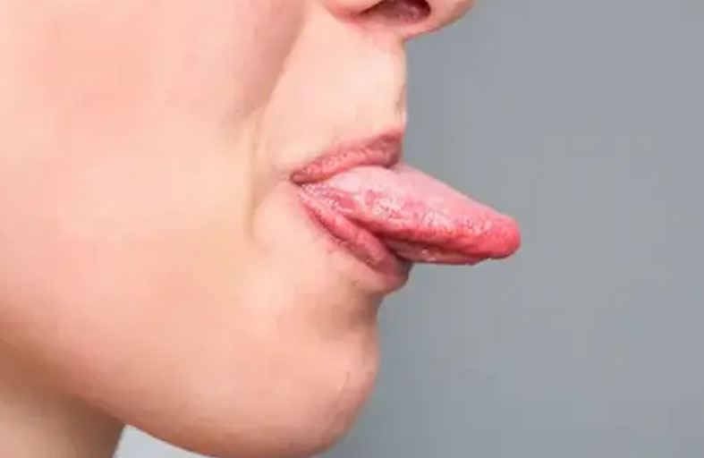 الأسباب الرئيسية لسرطان اللسان