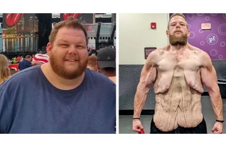 صورة صادمة لرجل خسر 152 كيلو من وزنه