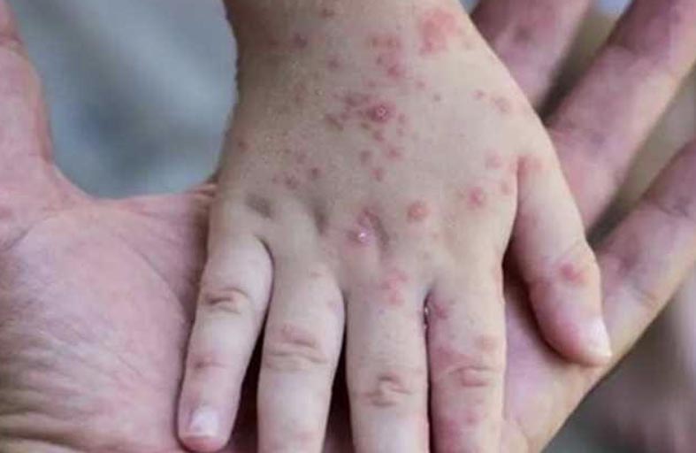 فنزويلا تعلن عن أول إصابة بجدري القرود