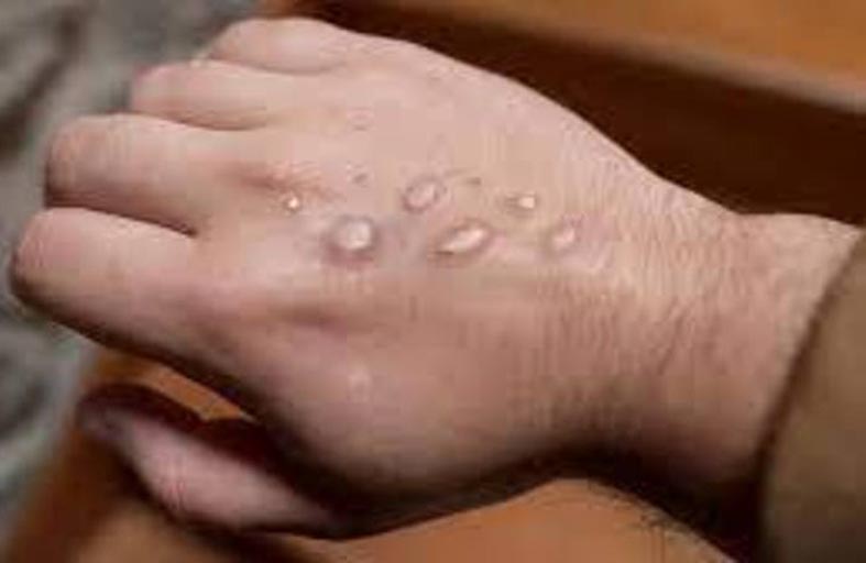 أول وفاة بجدري القردة خارج أفريقيا