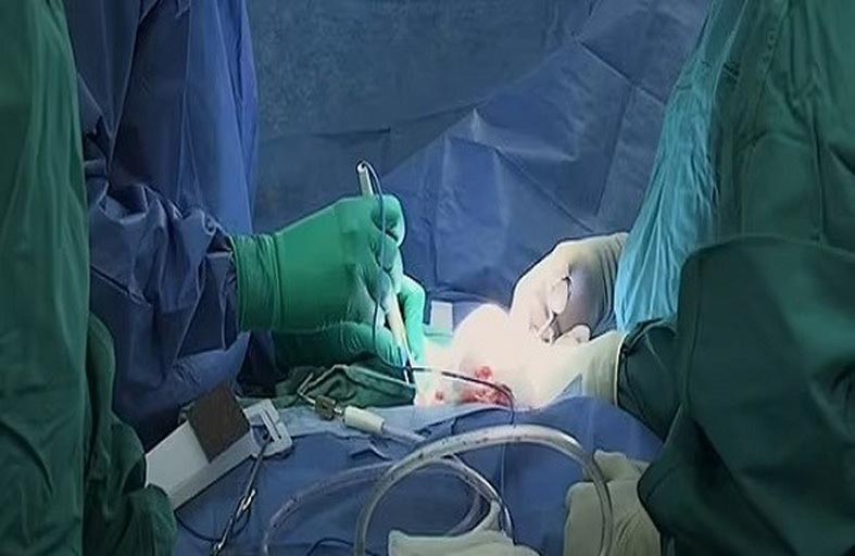 أول زراعة قلب باستخدام الأنسجة الحية