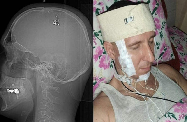 عالم روسي يجري جراحة ذاتية في الدماغ للتحكم في الأحلام