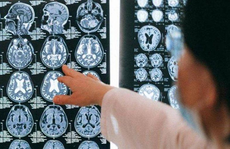 الذكاء الاصطناعي لتشخيص الخرف