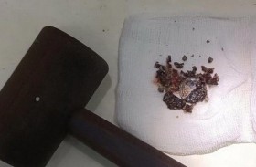 يعيش مع قطعة نقدية في أنفه 53 عاماً