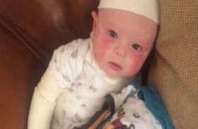 طفل يلف مثل المومياء بسبب الأكزيما