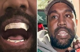 كانييه ويست يدفع مبلغاً ضخماً من أجل «طقم أسنان»