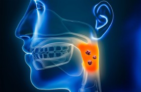 مشروبات شائعة الاستهلاك قد تسبب سرطان الفم القاتل