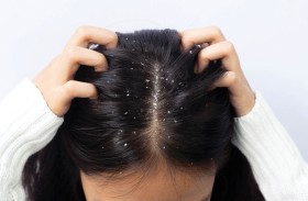 كيفية التخلص من قشرة الرأس بحسب الأطباء