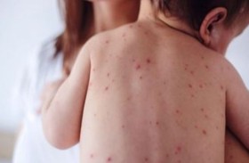 طبيب يحدد أعراض الحصبة