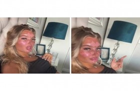 نتيجة مرعبة لفتاة أمضت 40 دقيقة في السرير الشمسي