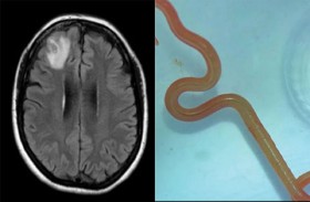 دودة حية في دماغ امرأة