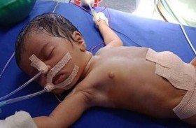 ولادة رضيعة بثمانية أجنة في بطنها