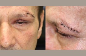 «بكتيريا قاتلة» تهدد عيون 3 رجال