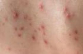 طرق الإفلات من متلازمة الجلد المحمص