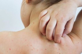 وفاة طفل بعد تعافيه من الحصبة تعيد دق ناقوس الخطر