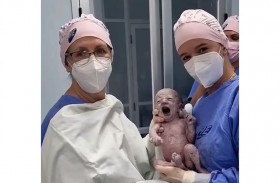 ولادة مدهشة لطفلة داخل الكيس الأمنيوسي