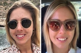 تعالج نفسها من البثور باستخدام مرشح لمياه الاستحمام