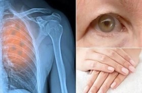 علامات تحذيرية غير متوقعة لسرطان الرئة