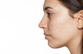 5 أسباب لظهور حب الشباب والبثور بشكل مفاجئ