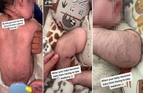 الشعر يغطي جسد رضيع بسبب دواء